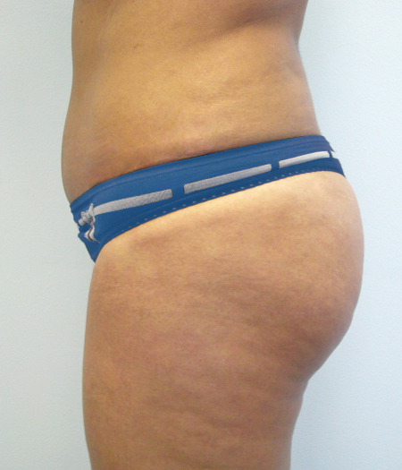 After Image: Patient # 47047 - 