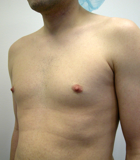 Before Image: Patient # 74223 - 
