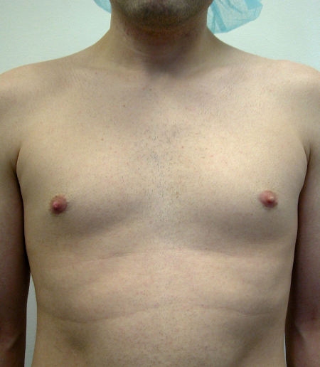 Before Image: Patient # 74223 - 