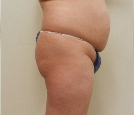 Before Image: Patient # 40971 - 