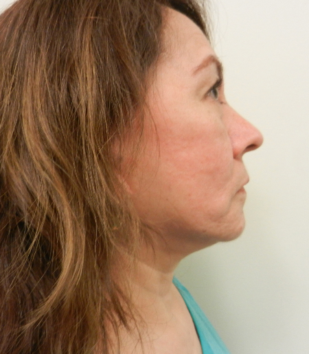 After Image: Patient # 29556 - 