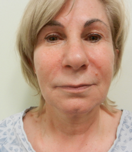 Before Image: Patient # 26603 - 