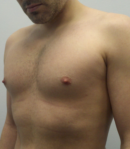 After Image: Patient # 74223 - 