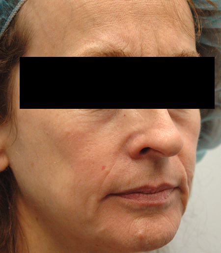 Before Image: Patient # 41753 - 