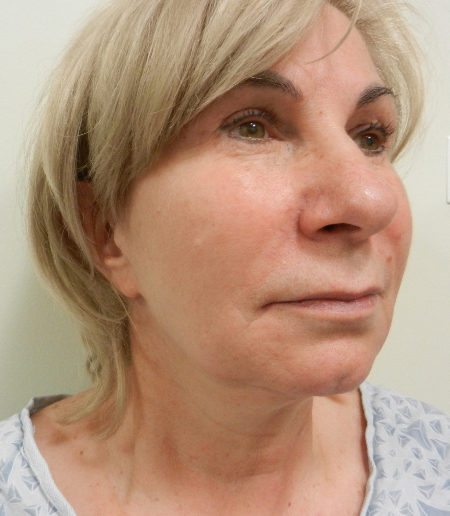 Before Image: Patient # 26603 - 