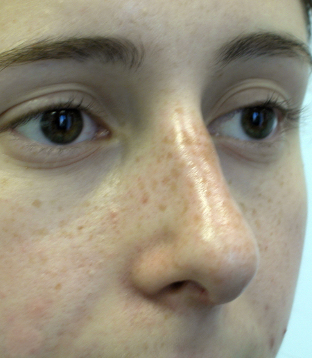 After Image: Patient # 81117 - 