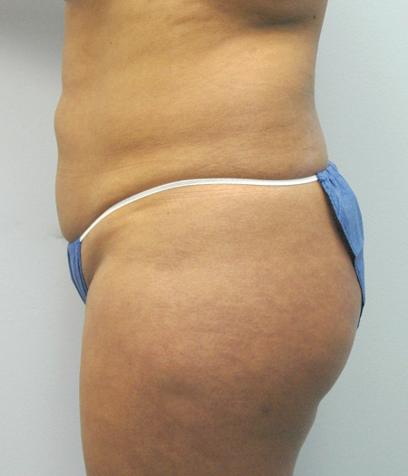 Before Image: Patient # 45728 - 