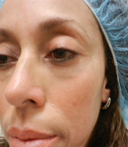 Before Image: Patient # 92852 - 