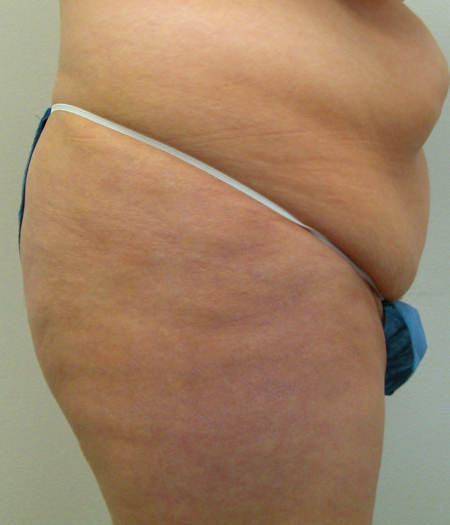 Before Image: Patient # 65165 - 