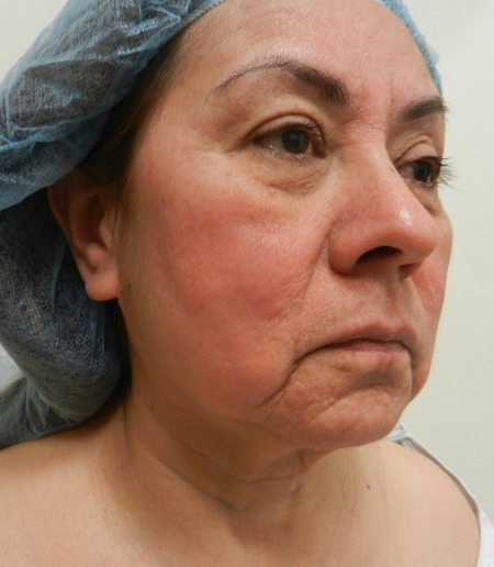 Before Image: Patient # 29556 - 
