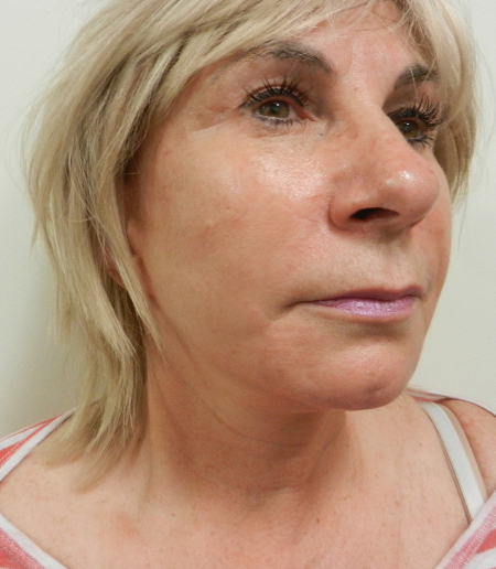 After Image: Patient # 26603 - 
