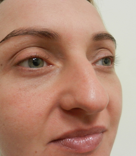 Before Image: Patient # 32662 - 