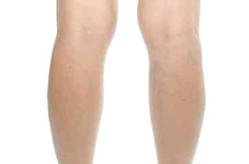 varicose veins