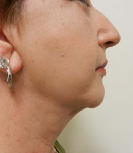 After Image: Patient # 67366 - 