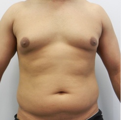 Before Image: Patient # 93529 - 