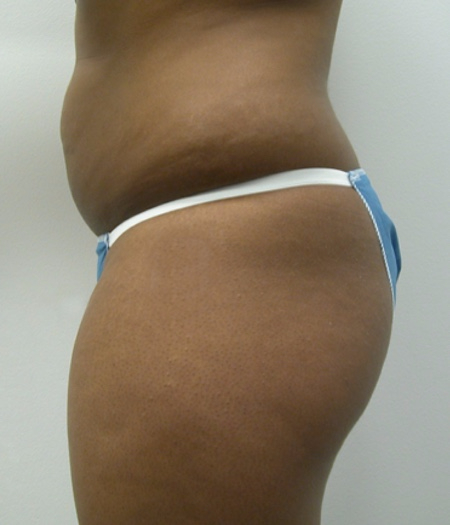 Before Image: Patient # 93332 - 