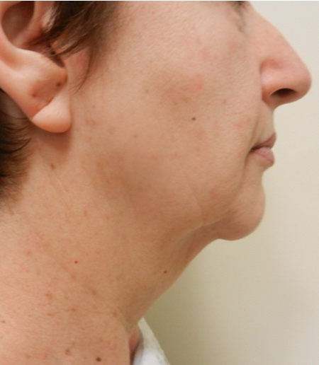 Before Image: Patient # 67366 - 