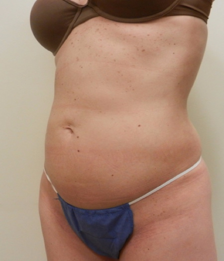 After Image: Patient # 84113 - 