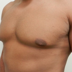 After Image: Patient # 93529 - 