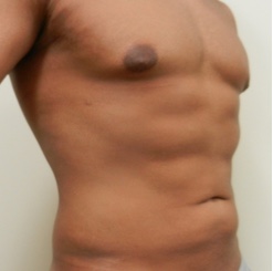 After Image: Patient # 93529 - 
