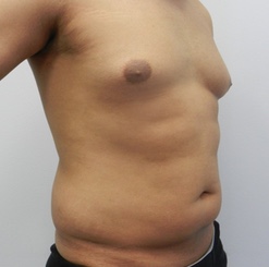 Before Image: Patient # 93529 - 