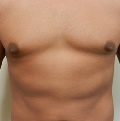 After Image: Patient # 93529 - 