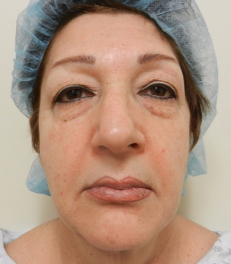 Before Image: Patient # 67366 - 