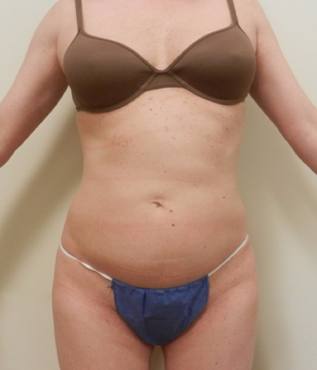 After Image: Patient # 84113 - 