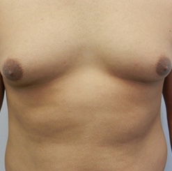 Before Image: Patient # 93529 - 
