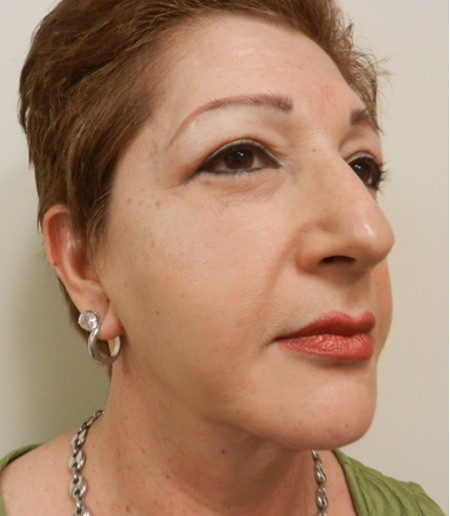 After Image: Patient # 67366 - 