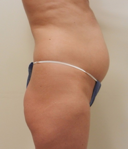 Before Image: Patient # 84113 - 