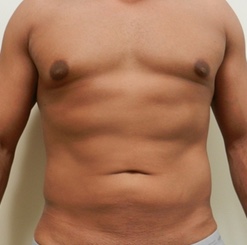 After Image: Patient # 93529 - 