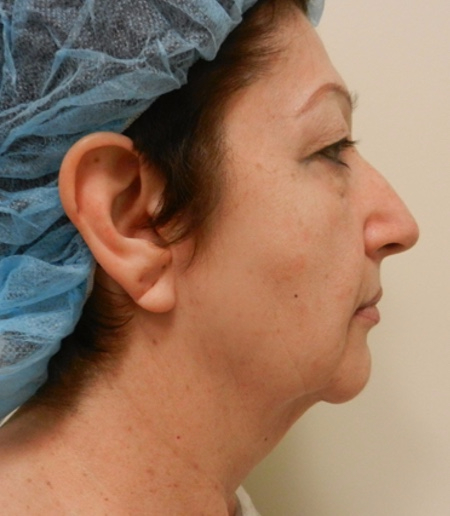 Before Image: Patient # 67366 - 