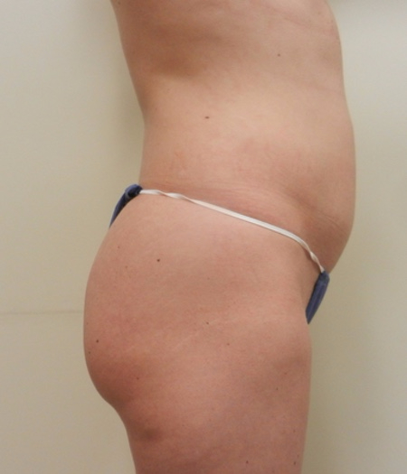 After Image: Patient # 84113 - 