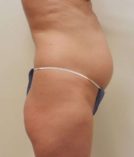 Before Image: Patient # 84113 - 