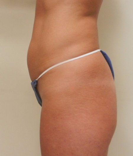 Before Image: Patient # 76406 - 
