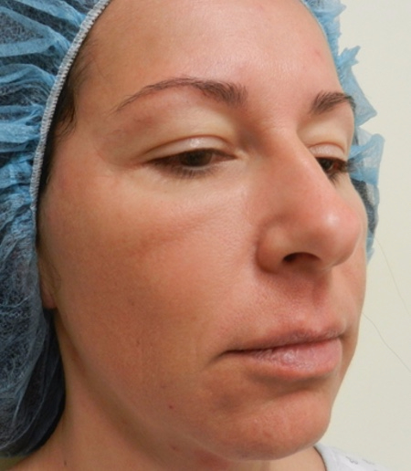 Before Image: Patient # 66548 - 
