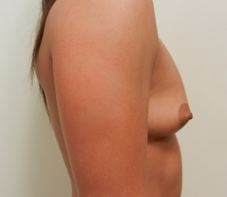 Before Image: Patient # 17374 - 