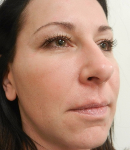 After Image: Patient # 66548 - 