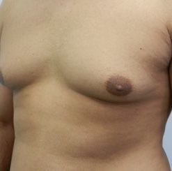 Before Image: Patient # 93529 - 
