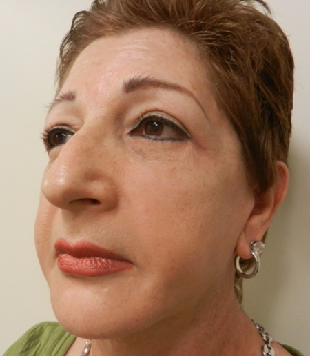 After Image: Patient # 67366 - 