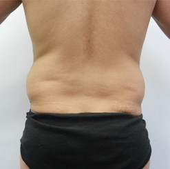 Before Image: Patient # 93529 - 