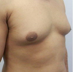 Before Image: Patient # 93529 - 