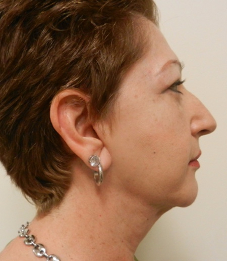 After Image: Patient # 67366 - 