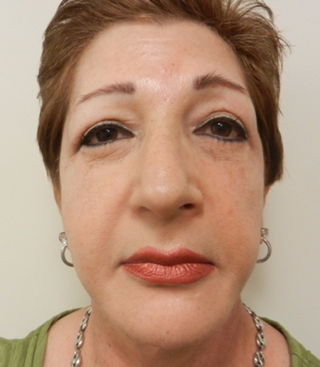 After Image: Patient # 67366 - 
