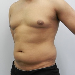 Before Image: Patient # 93529 - 