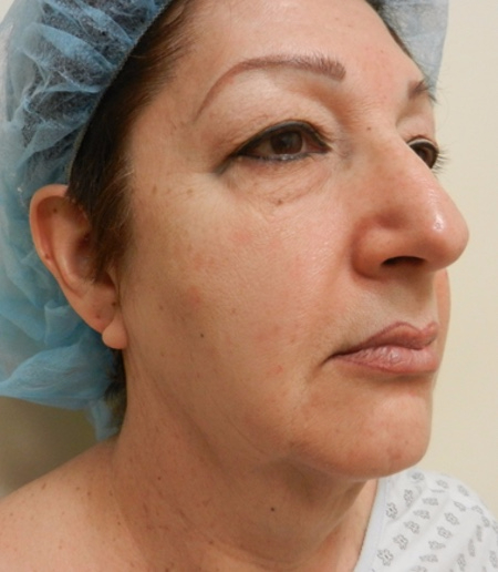 Before Image: Patient # 67366 - 