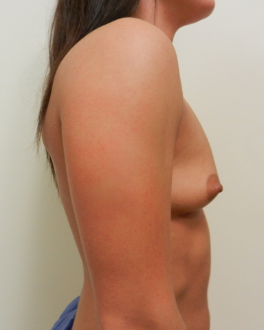 Before Image: Patient # 87582 - 