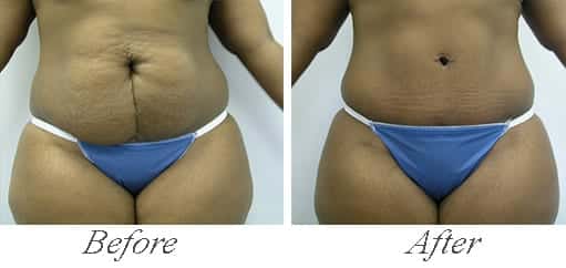 Tummy Tuck Chicago, IL
