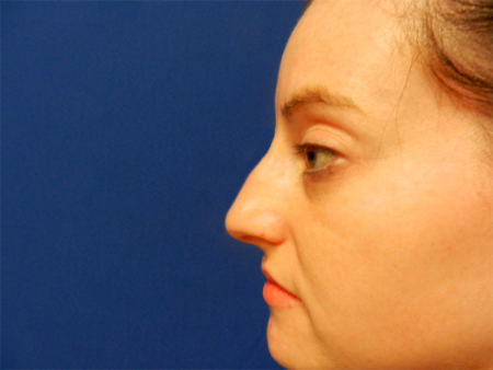 Before Image: Patient # 51244 - 